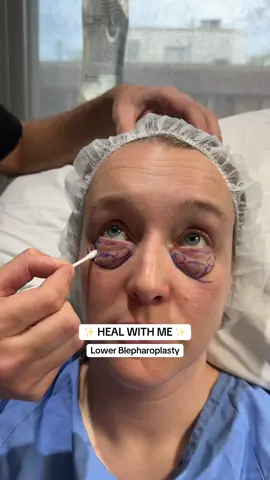 This amazing patient came to us feeling self-conscious about under-eye bags that made her look tired. We performed a lower blepharoplasty with fat transposition, which carefully repositions the patient's own fat to smooth and rejuvenate the under-eye area. 👁️✨ Seeing her confidence grow throughout her healing process has been truly rewarding! 🫶 Have you ever wondered about the difference between fat transposition and traditional blepharoplasty? Ask your questions below! 👇 #lowerblepharoplasty #eyelidsurgery #montreal #fatgrafting #fattransposition  