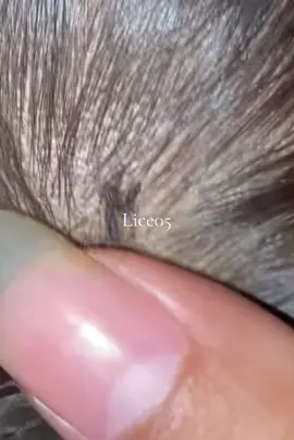 😱😱😱#omg #lice #liceremoval 