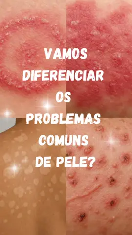 Venha conhecer as diferenças! #sarnahumana #manchasdepele #biomedicinaestética #conhecimento #organismo #cuidadoscomasaúde 