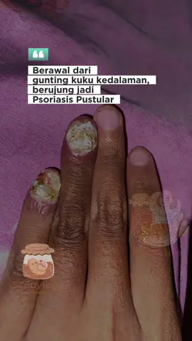 Cerita dari kakak ini bener bener mengherankan aku...  Dari awal diagnosa jamur di kuku, sampai kuku dicabut, kalu minum obat jamur, lalu jadi meradang sebadan akhirnya di diagnosa Psoriasis Pustular  cerita perjalanan yang sangat panjang menemukan jalan keluar dari kondisi Psoriasis Pustular  hingga akhirnya kakak ini menemukan @MAMBUCHA @Scobylogy Probiotic Skincare di tik***  Namun hanya ingin bilang, apapun yang kamu hadapi saat ini, percayalah, masih ada harapan... beroda , berharap, ikhtiar ada jalan keluarnya ❤️❤️ 6 hari penuh keajaiban , Minum @mambucha.id  oles scogel dan scotion @scobylogy 🥹 Tubuh yang tadinya kaku tidak bisa digerakan kini sudah kembali bisa digerakkan dengan leluasa , Puji Tuhan , Alhamdulillah ❤️❤️❤️🥹😭  Hope for #Psoriasis #Autoimun #Autoimmune