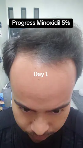 Progress Minoxidil 5% 176 Hari. Baru cukur rambut ges hehe #minoxidil #alopecia #botak #genetik #rambutrontok 