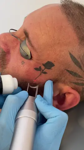 Face tattoo removal ⚡️ not even a flinch #lasertattooremoval #tattooremoval #sheffield #leeds 
