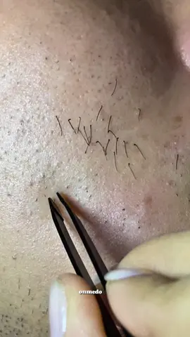 Không tuột, không đứt, nhổ râu đỉnh thế này thì còn chần chờ gì nữa? #nhorau #nhipnhorau #nhip #bonhipnghieng #waxing 