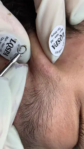 Êm #chamsocdamun#chamsocdanam#chamsocdaseo#lequynhspa#hocnghespa 