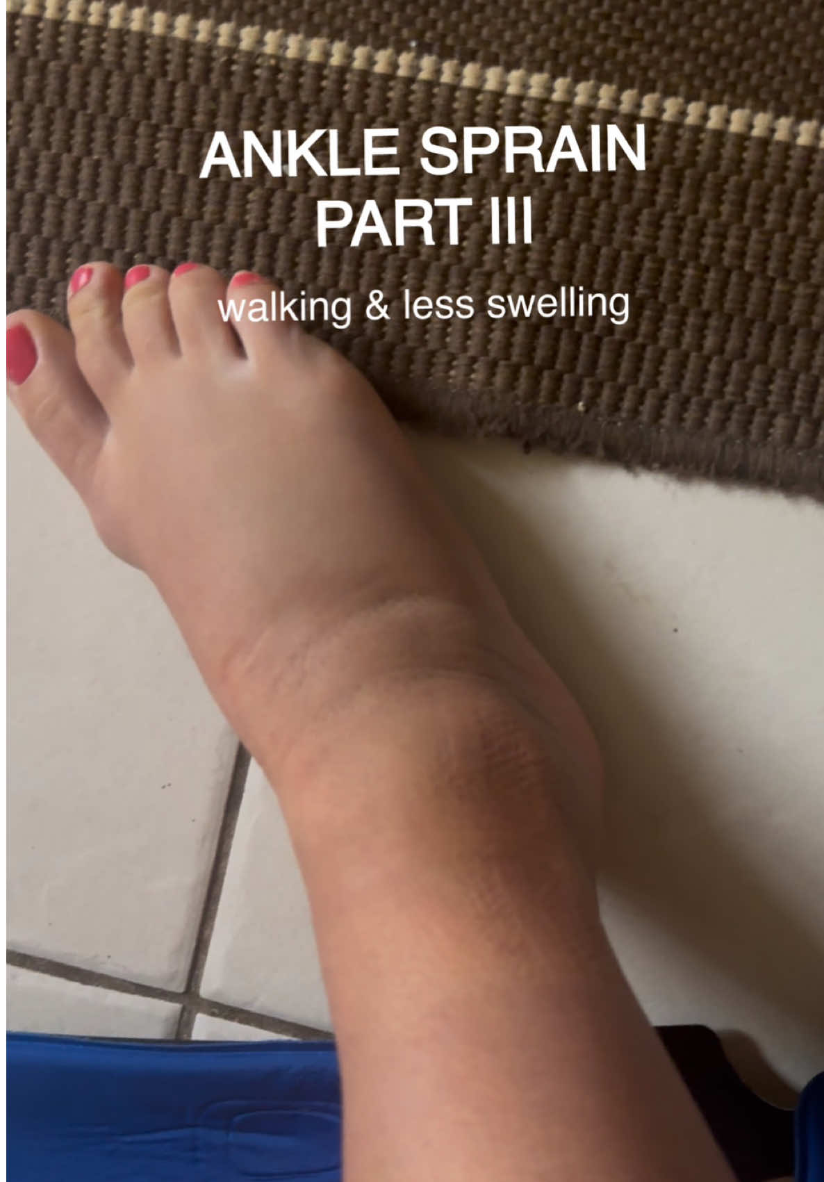 From a and strain to walking & training (upper ofc) by day 3-4 🦶🏻👀 Here’s exactly what I did. Changed the ice pack every 20 mins. Elevated as much as possible and tried to walk, put my weight on (as much as it allowed me to) Everyday, it got better ! Speed up your recovery ❤️‍🩹  #anklesprain #sprainedankle #rehab #injury #injuryrecovery 