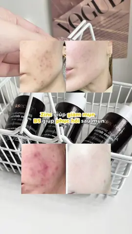 Vẫn là combo “đỉnh nóc” của nhà Ekseption cho team da dầu mụn nên thử nha #ekseption #skincare #serum #znpcaserum #b5 