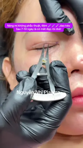 Nâng mí không phẫu thuật, dao kéo , tiêm 💉💉#Nângmikhongphauthuat #Plasmaxoadanepmi #nguyennhiplasma #dayplasma #nhấn_mí_không_xâm_lấn_plasma 