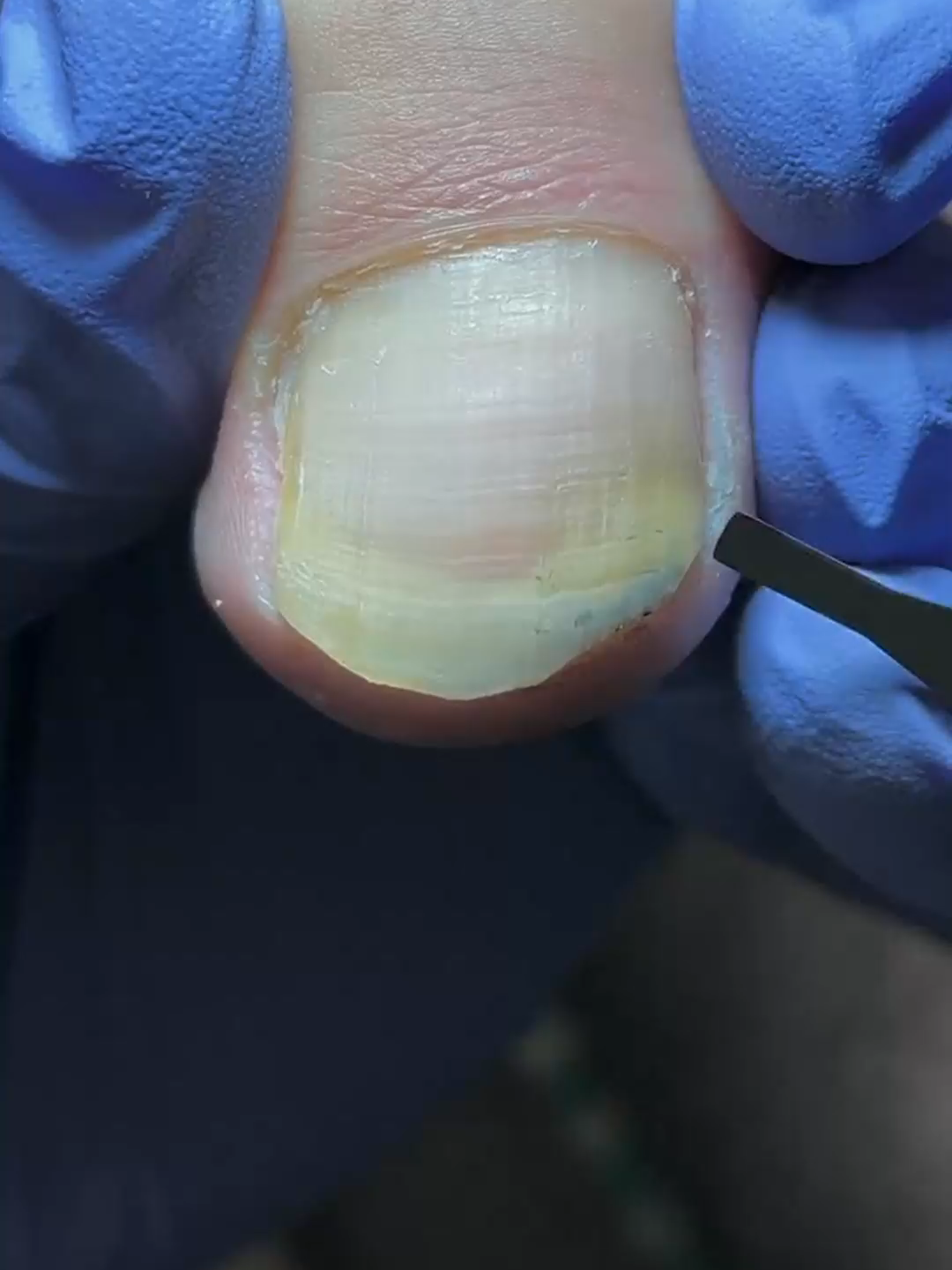 #nails #asmrnailsalon #pedicure #asmr #asmrnails #toecleaning