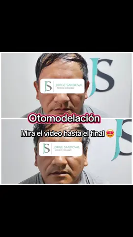 RESULTADOS EXCELENTES DE OTOMODELACIÓN. #otomodelacion #otoplastia #trujilloperu #estetica #follow 