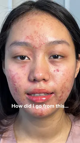 Tonton sampe habis = muka langsung glowing 🤪⚡️ #skinjourney #bekasjerawat #glowing #glasskin #fyp 