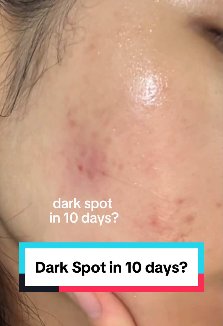 Dark spot in 10 days? Would you try this?👀 In collaboration with @AXIS-Y Store US  #creatorsearchinsights #axisy #axisglowserum #kbeautyskincare #koreanskincare 