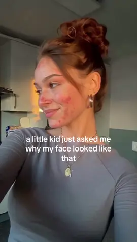 #skincare #acne #skincareroutine 