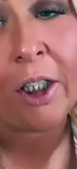 Rotten teeth send help #gingivitis #needadentist #funnyvideos #toothdecay😢 