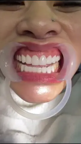 Extra white 😍 #veneers #porcelainveneers #veneerceramic #veneeremax #indirectveneers 