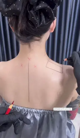 ✨ TIÊM THON GỌN BẮP TAY – HẠ CẦU VAI ✨ 💉 Giải pháp cho vai u, bắp tay to – không cần tập luyện! ✔️ Thư giãn cơ, giảm đau vai gáy – bó cơ ✔️ Hiệu quả rõ chỉ sau 1 lần tiêm ✔️ Không sưng – không đau – không cần nghỉ dưỡng 📍 Hà Nội – Sài Gòn – Ninh Bình – Quảng Ninh – Hải Phòng – Đà Nẵng 🏠 Nhận lịch tiêm tại nhà: nhanh – kín đáo – tiện lợi 📞 0981.822.561 #TiêmĐẹpAnToàn #ĐẹpTựNhiên #filler #botox #fillerbotoxhanoi 