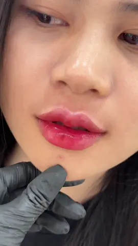 Tiê.m này đủ tự nhiên chưa ạ✅#filler #tiemmoi #moixinh #fillerbotox #moibaby 