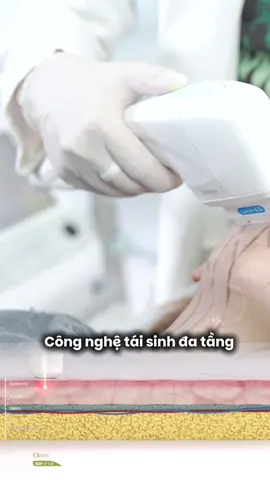 HIFU - PHƯƠNG PHÁP TRẺ HOÁ KHÔNG XÂM LẤN #drlinhclinic #xh  #bacsidalieu 