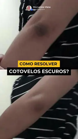 ✨ Cotovelos escuros? Tem solução! No nosso centro dermatológico, combinamos tecnologia de ponta com protocolos personalizados. 💡 Tratamento indicado: laser para uniformizar a tonalidade + Ureadin 20 para hidratar e renovar a pele. Somos referência em dermatologia há 20 anos, com todos os equipamentos necessários para cuidar da sua pele com segurança e resultado. 📍 Centro de Tecnologia Dermatológica: confiança, experiência e inovação para você se sentir bem na sua própria pele. #Dermatologia #PeleBonita #TratamentoLaser #CuidadosComAPele #CotovelosClaros