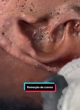 removendo cravos da orelha 😱😱😱 #cravossatisfatorios #blackhead #satisfyingvideo #videosatisfatorio #foryou 