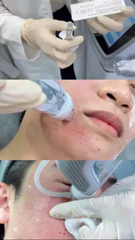 Mesotherapy với rejuran vị khách việt kiều test máy Reme pro9 #mesotherapy #rejuran #remee #remepro9 