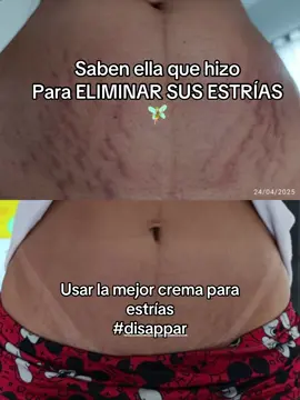 Mejora las estrías 🫶🏻con dísappear ❤️ #disappear #estrias #estriasembarazo #estriasbrancas #estriasroja 