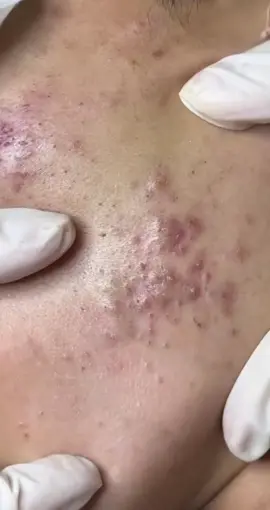 #GòVấp #bentre71🌴🥥 #nguyenchuyenmun 