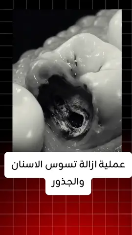 عملية ازالة تسوس الاسنان والجذور  #dentistry #medicine #تقويم_الاسنان #طب #زراعة_اسنان 