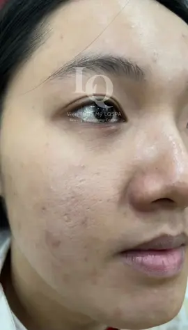 Cập nhật da mụn thâm sẹo #chamsocdamun#chamsocdanam#chamsocseo#lequynhspa#nanmunbangtay 