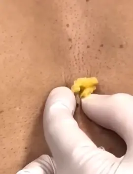 💣💕 #espinhasecravos  #fyp  #espinha  #fyppppppppppppppppppppppp 