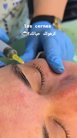 علاج الهالات السوداء #خنشلة_باتنة_ام_البواقي_سطيف_شاوية #تبسة_بئرالعاتر_الشريعة_الجزائر #syabeautyclinic #cernes #هالات_سوداء @docteur assia taabni 