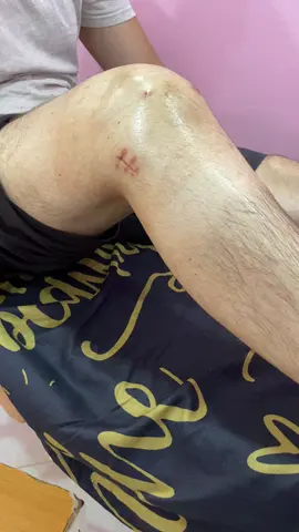 اول حصة من العلاج الفزيائي   La première séance de physiothérapie après ine intervention chirurgicale du ménisque suture après 45 jours du #المغرب🇲🇦تونس🇹🇳الجزائر🇩🇿تركيا🇹🇷_العراق🇮🇶 #massage #خليها_على_ربي #صحتكم_تهمنا #صحتكم_تهمنا 