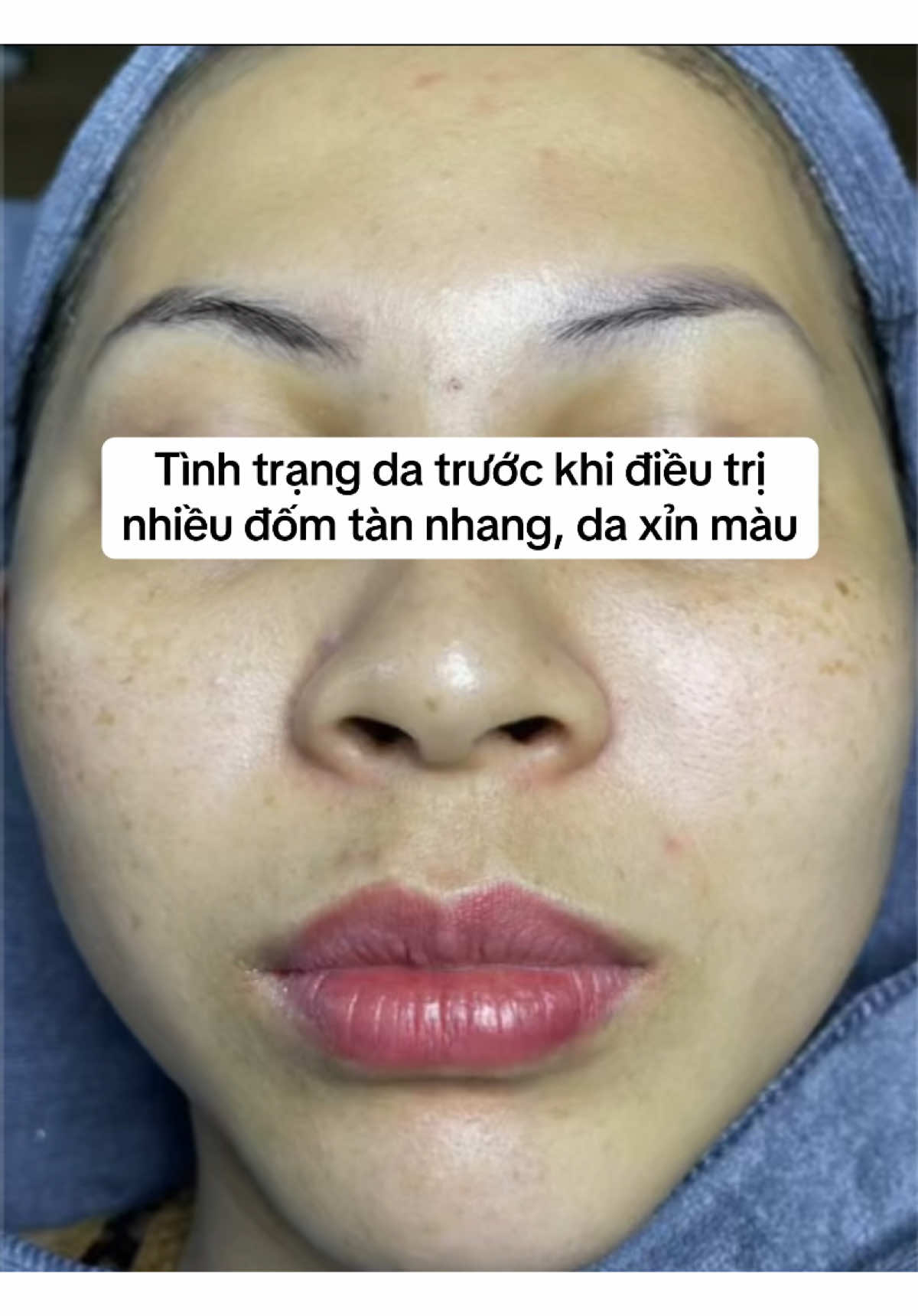 Từ làn da đầy tàn nhang đến sạch mịn chỉ sau 1 liệu trìn. Nói KHÔNG với filter, KHÔNG chỉnh ảnh. Da thật - kết quả thật 💯 Ai đang tự ti vì da nám, tàn nhang xem ngay kết quả thực tế 👇 #tudorisbeautyspa #tannhang #tritannhang #lamdep #spadanang 