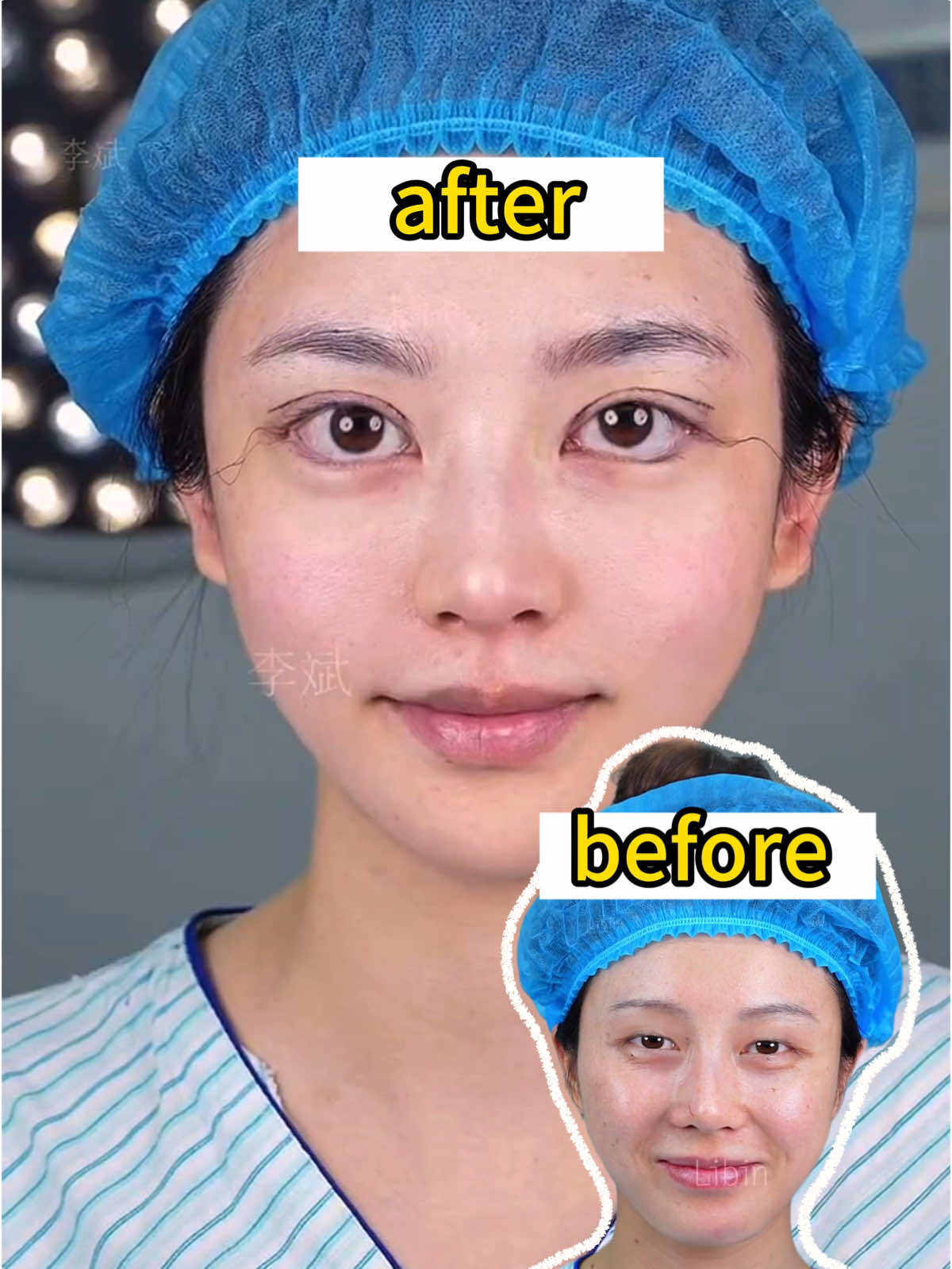 眼部显老疲惫，做完眼综合🍠之后既然显得年轻了。 The eyes looked aged and tired, but after undergoing an eye composite surgery, they now appear much younger.   #整容 #上海 #眼综合 #双眼皮 #eye #eyes #beauty #medical #medicalbeauty #plasticsurgery 