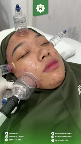 Buat sahabat hamdalah yang mengalami jerawat parah bisa langsung konsultasi ke Hamdalah  Kunjungi kami di alamat : Hamdalah Pusat 📍 Jl. Abd Daeng Sirua no.59B (400 meter dari arah pettarani) Cabang Gowa 📍 Jl. Tun Abdul Razak No.1, Hertasning Baru (Dekat Pertamina depan Giant) Cabang Parepare  📍Jln.Jend.Ahmad Yani km 2 (dekat masjid agung Parepare) no hp 08115050555      #BekamHamdalah #BekamSteril #bekamsehat 