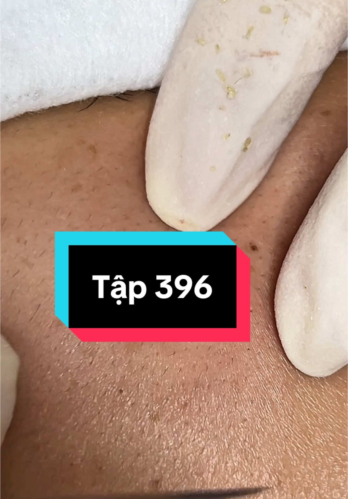 Mụn mũi #skin #skincare #mun #mundial #skincareroutine #skincaretips 