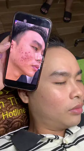 Cập nhật da mụn thâm sẹo #chamsocdamun#chamsocdanam#chamsocseo#lequynhspa#nanmunbangtay