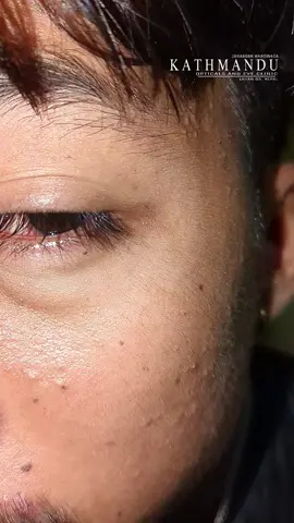 Microsporidial or Viral SPK Alert !  Red, watery & irritated eyes with tiny surface spots may be due to viral infection. Protect your eyes, avoid touching & seek proper care!  👉 Key diagnostic pearl: If you see many white spots on cornea and fluorescein shows incomplete / irregular staining, think microsporidia. If all the spots stain clearly as fine punctate dots, think SPK.  #eyecare #ophthalmology  #eyehealth  #optometry  #viralinfection 