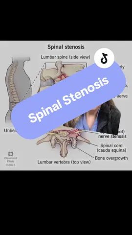#spinalstenosis #painmanagement #spine 