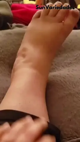 🎯 Chega de pernas cansadas e inchadas! A meia de compressão com zíper é prática, fácil de vestir e realmente faz a diferença no seu dia a dia. ✅ Melhora a circulação ✅ Reduz inchaço e dores ✅ Mais energia nas pernas ✅ Conforto e praticidade com zíper Se você passa muito tempo em pé ou sentado, essa é a solução que suas pernas estavam pedindo! 🦵✨ 🔥 Trabalhamos com produtos originais e de qualidade, nada de imitações fajutas! 👉 Garanta a sua agora mesmo! #meiacompressao #pernascansadas #circulacaosanguinea #saudeebemestar #vidasaudavel 