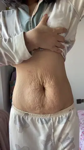 Does your husband dare to touch this stomach？ #pregnancy #pregnantmama #stretchmarks #pregnancystretchmarks #BrilhaSemMedoEstácio 