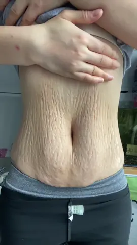 Does your husband dare to touch this stomach？ #pregnancy #pregnantmama #stretchmarks #pregnancystretchmarks #BrilhaSemMedoEstácio 