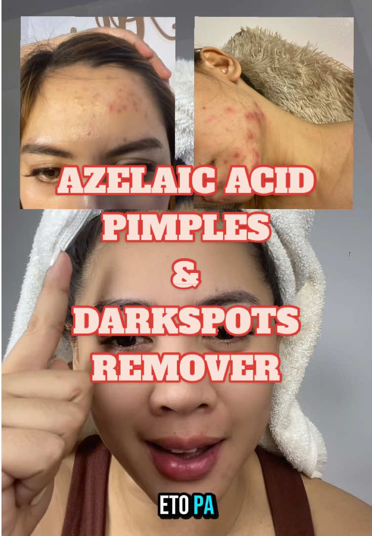 Pimples, darkspots, pekas, melasma & redness remover #azelaicacid #pimple #acne #acnetreatment #acneproneskin 