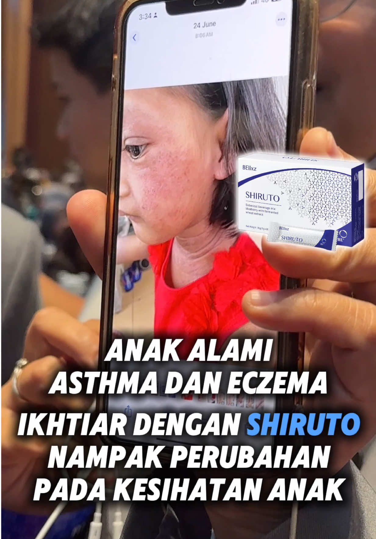 Anak Kak Da memang ada asthma dan eczema, dan dua-dua ni saling berkait rapat. 👉 Bila eczema flare, asthma akan datang. 👉 Bila asthma datang, esoknya eczema pula jadi teruk. Dulu, setiap minggu atau dua minggu sekali memang akan ada flare teruk, sampai pernah kena warded. --- 📌 Selepas Mulakan Shiruto 2 kotak pertama (±1 bulan): Masa ni kulit nampak macam tak ada beza, tapi Kak Da perasan langsung tak ada flare eczema. Masuk kotak ke-3: Kulit mula kering, luka-luka yang selalu anak garu tu mula sembuh. Dulu garu sampai luka berdaki tebal, tapi perlahan-lahan dah mula hilang. Selepas ±5 kotak: Flare eczema terus hilang. --- Kini, ✔️ Kulit anak dah kering & pulih — cuma tinggal parut hitam bekas garu. ✔️ Dah jarang sangat kena serangan asthma. ✔️ Tak perlu lagi risau pasal flare teruk setiap minggu. Permulaan memang konsisten bagi 2 hingga 4 sachets setiap hari Sekarang cuma maintain Shiruto 1–2 sachet sehari, kadang-kadang 2–3 hari sekali je. Alhamdulillah, dah boleh katakan hampir tiada flare langsung sekarang. --- Perjalanan ni ambil masa & konsistensi, tapi hasilnya sangat berbaloi. Dulu sentiasa terpaksa risau, sekarang anak boleh hidup lebih selesa tanpa asma & eczema yang teruk. #shiruto #shirutovitaminsofimmunity #eczema #asthma #anaksihat 