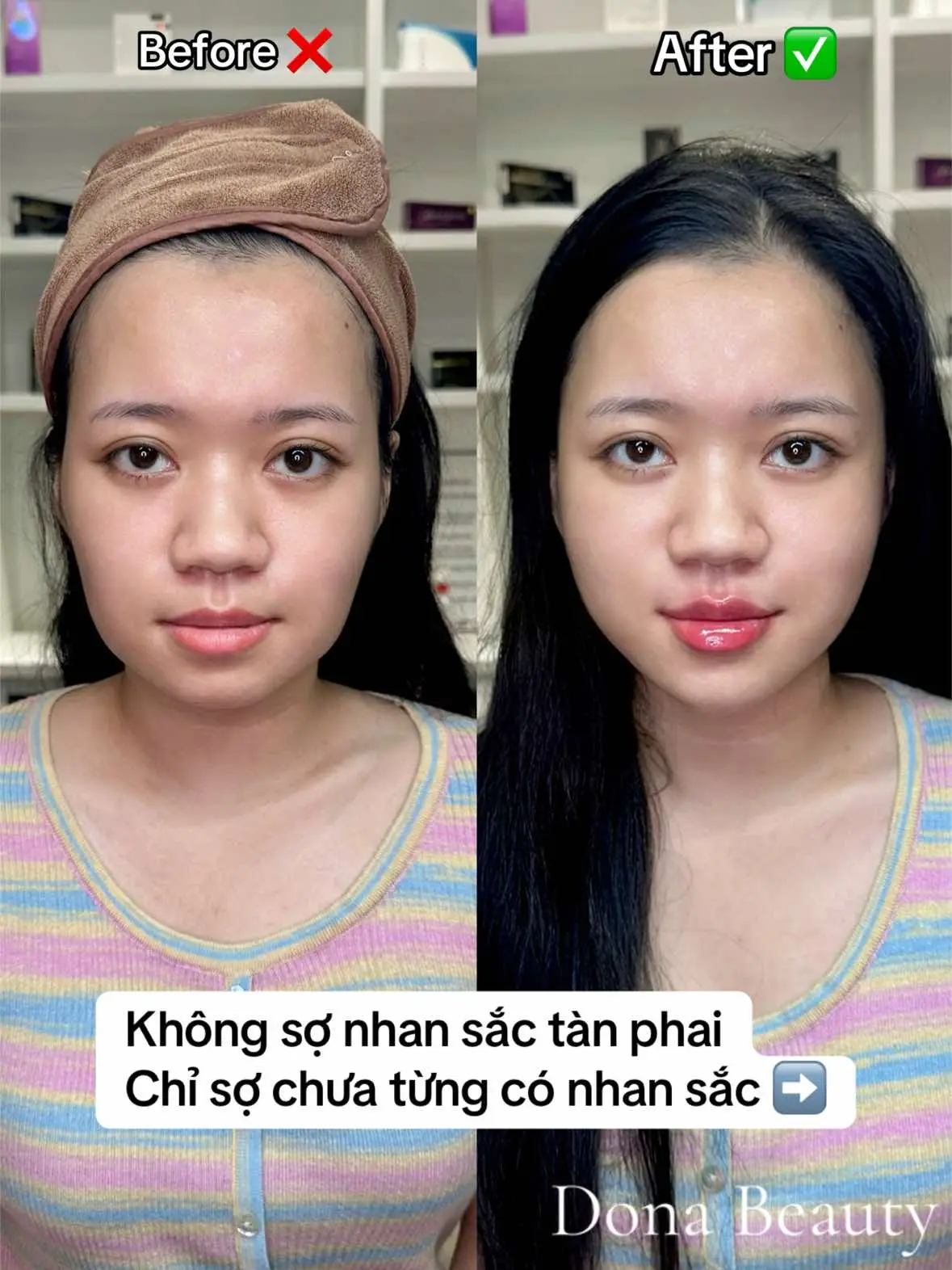 B.sĩ chính quy - Kinh nghiệm 8 năm Filler Botox , bao check thuốc test tan miễn phí #donabeauty #fillerbotox #filler #botox #meso #tiplamdep #moitunhien #fullface #tunhien #fillerfullface 