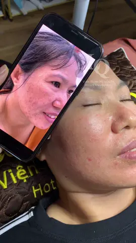 Cập Nhật da sạm nám #chamsocdamun#chamsocdanam#chamsocseo#lequynhspa#hocnghespa