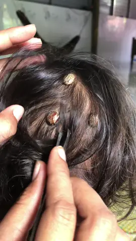 #fyp #fouryou #lice #removalticks #relatable 