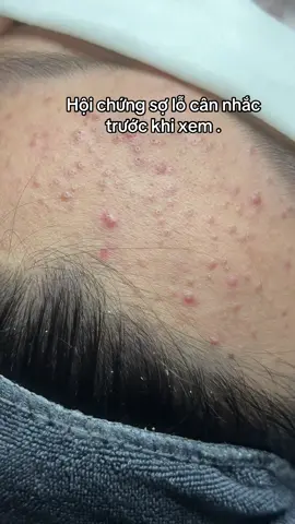 Thương khách thật sự #Thubeautyspa #nạnmunbangtay #nanmunchuanykhoa #trimuntritham #