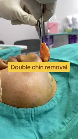 ไขมันเหนียง double chin removal #หมอกระต่ายที่คล้ายๆหมอกระเป๋า #ตัดเหนียงหมอกระต่าย #doublechin #fatremoval 
