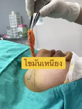 ไขมันเหนียง double chin #มาดามเมดิคอลคลินิก #MadamMedicalClinic #doublechin #ไขมันเหนียง 