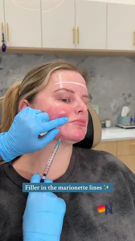 People get filler in the marionette lines to soften the downturned lines around the mouth and restore lost volume, which helps reduce sagging and deep creases. This treatment lifts and smooths the lower face, creating a more youthful and balanced appearance ✨💉  #filler #smilelines #restylane #happyhandsaesthetics #drsarshad 